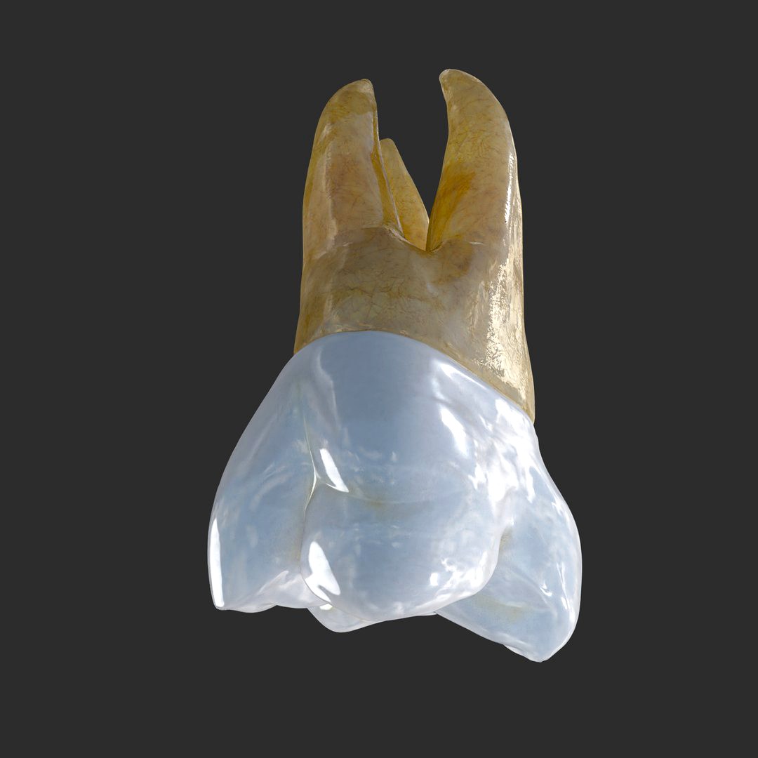 Upper First Left Molar