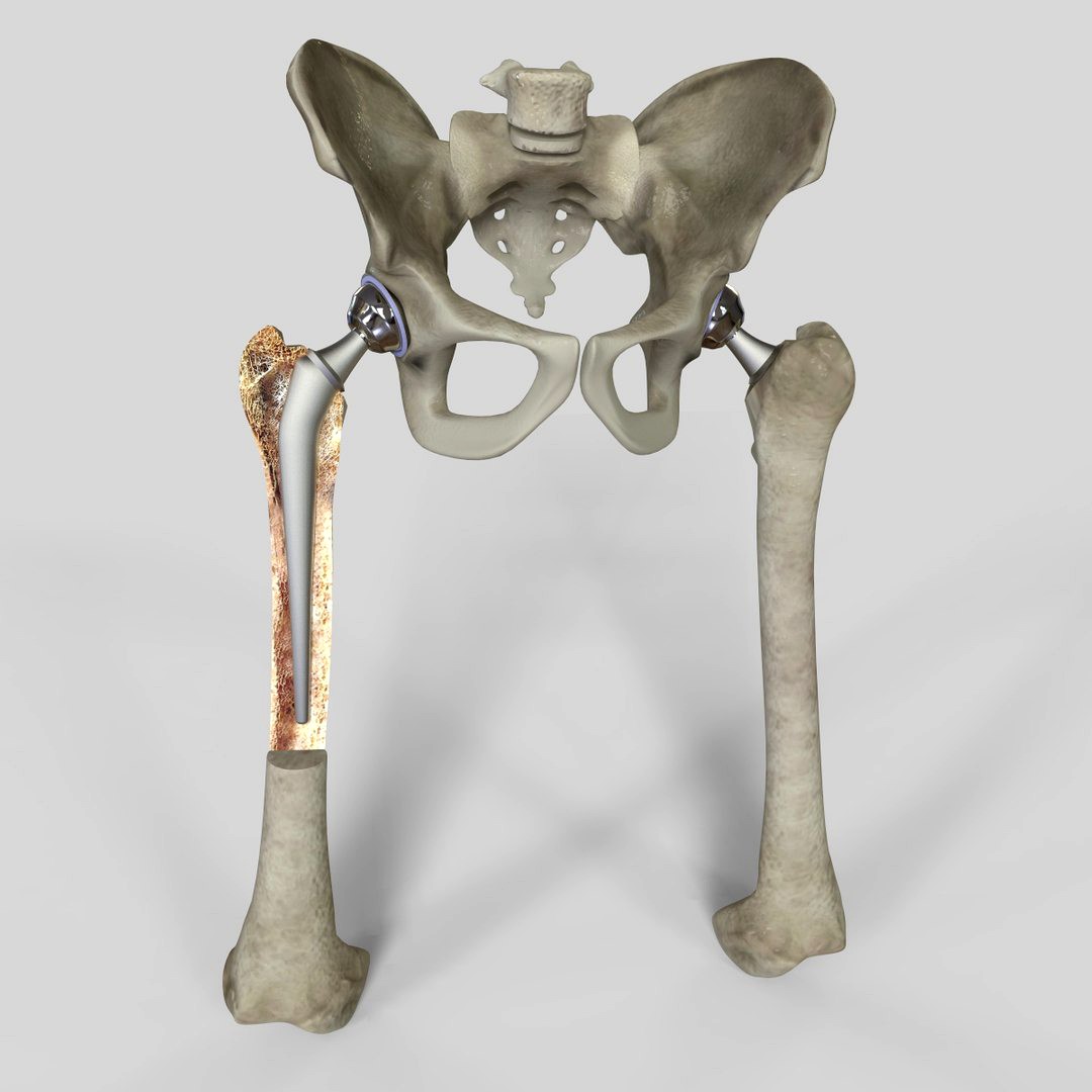 Hip replacement