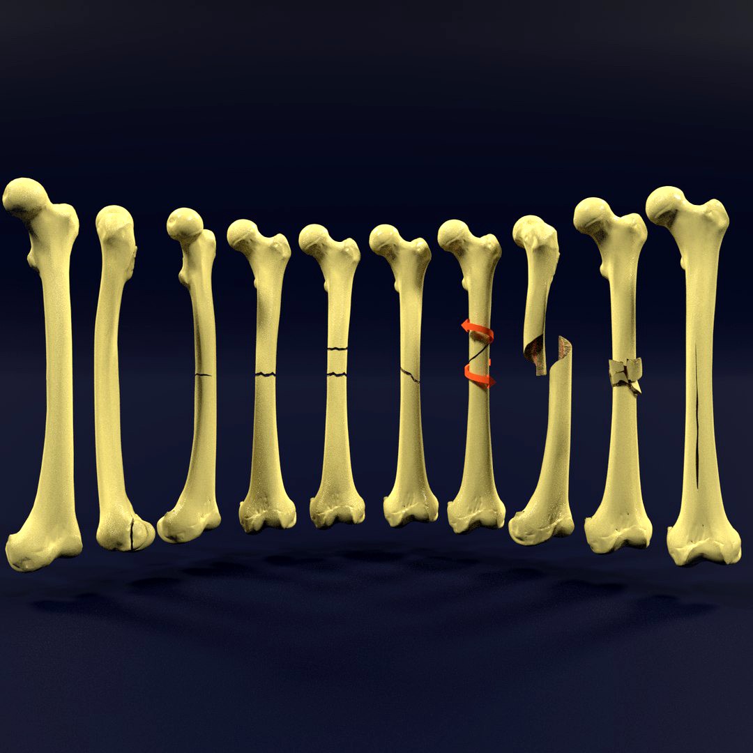 Fracture types labelled