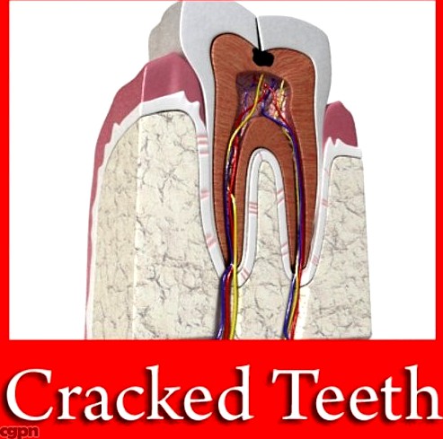 Cracked tooth with cavity3d model