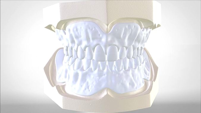 Digital Try-in Full Dentures for Injection Molding  | 3D