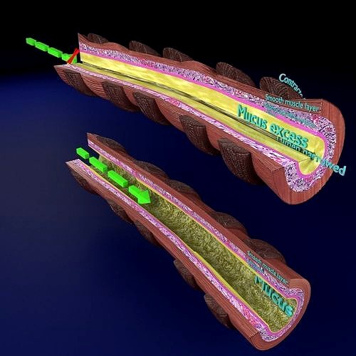 Asthma bronchiole obstruction