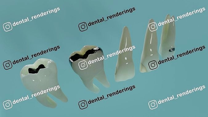 Dental restorations - Blacks Class I to V