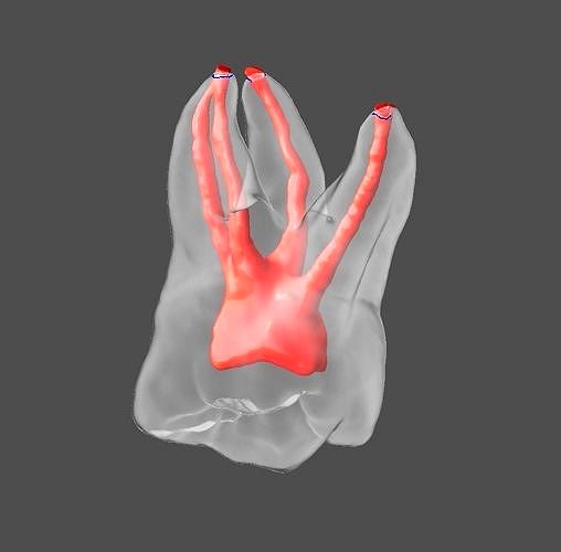 Maxillary 1st molar right and left with 4 canals | 3D