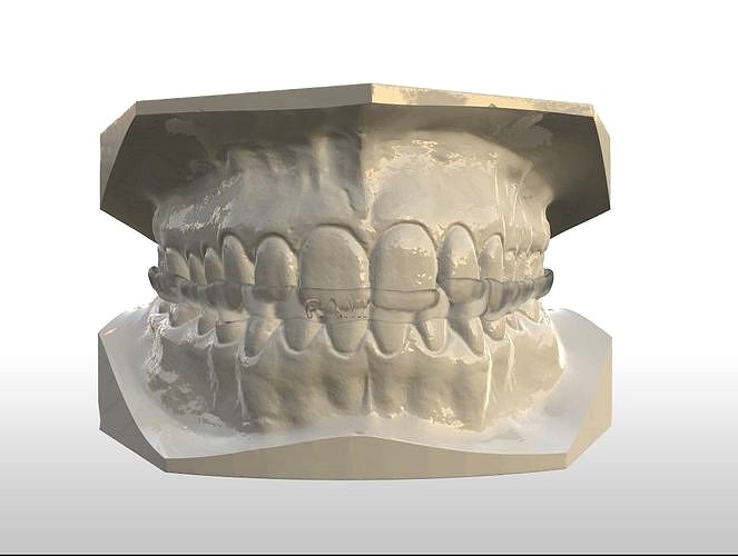 Full Coverage Occlusal Splint with Canine Guidance | 3D