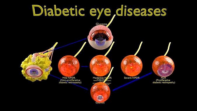 Diabetic eye diseases