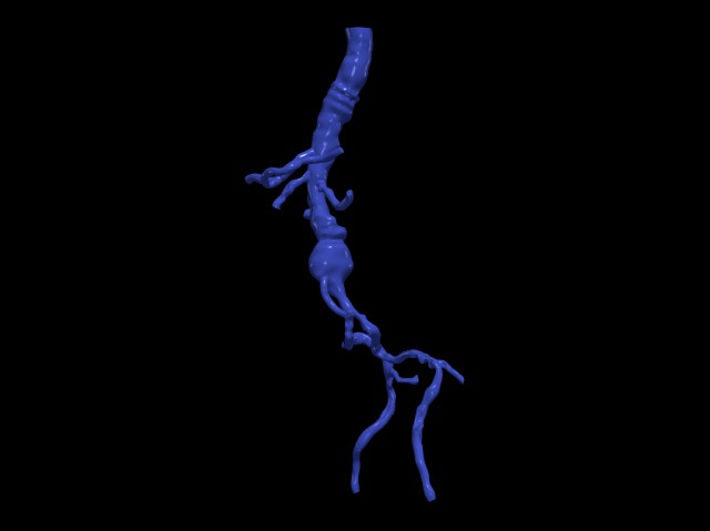 Aortofemoral