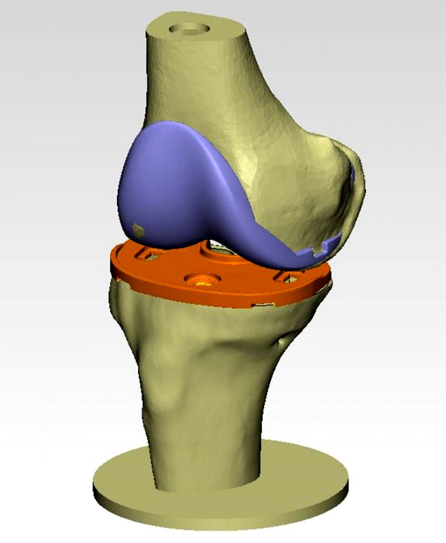 knee joint prosthesis with guides sample of individual prosthetics