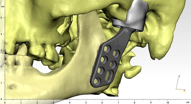 individual tmj prosthesis real operation