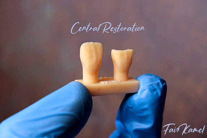 Dental Central Tooth Restoration V2 Composite Waxup  | 3D