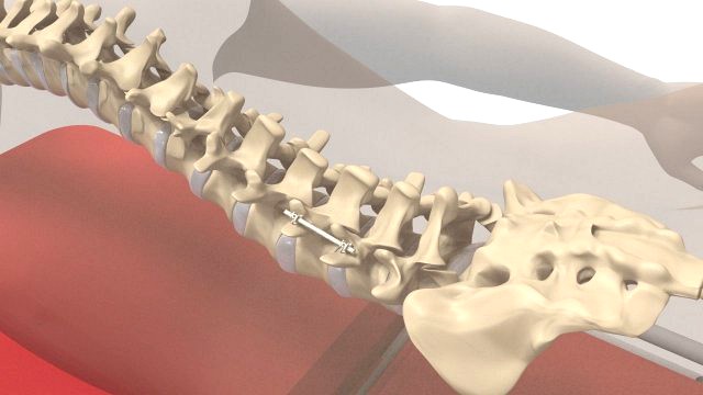 Human Spine and Implant