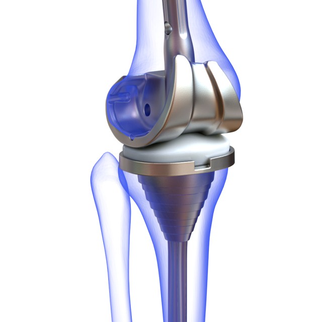 Knee Replacement Implant