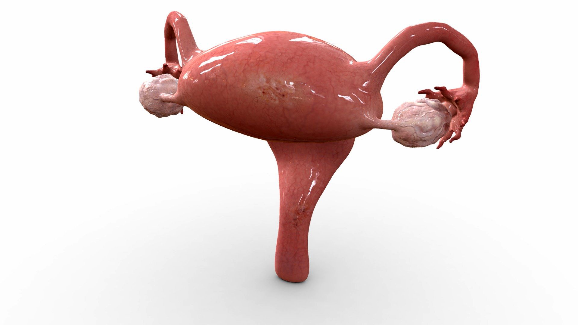 Uterus with Endometriosis