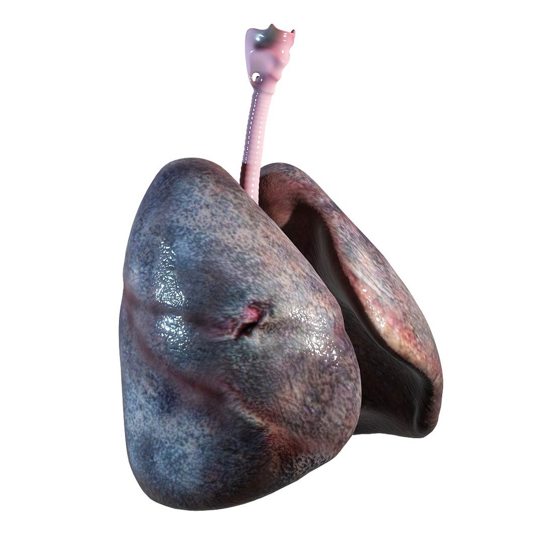 Human Smoker Lungs