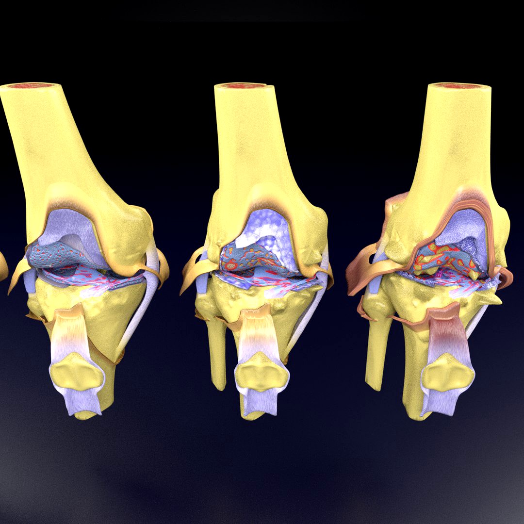 Osteoarthritis stages