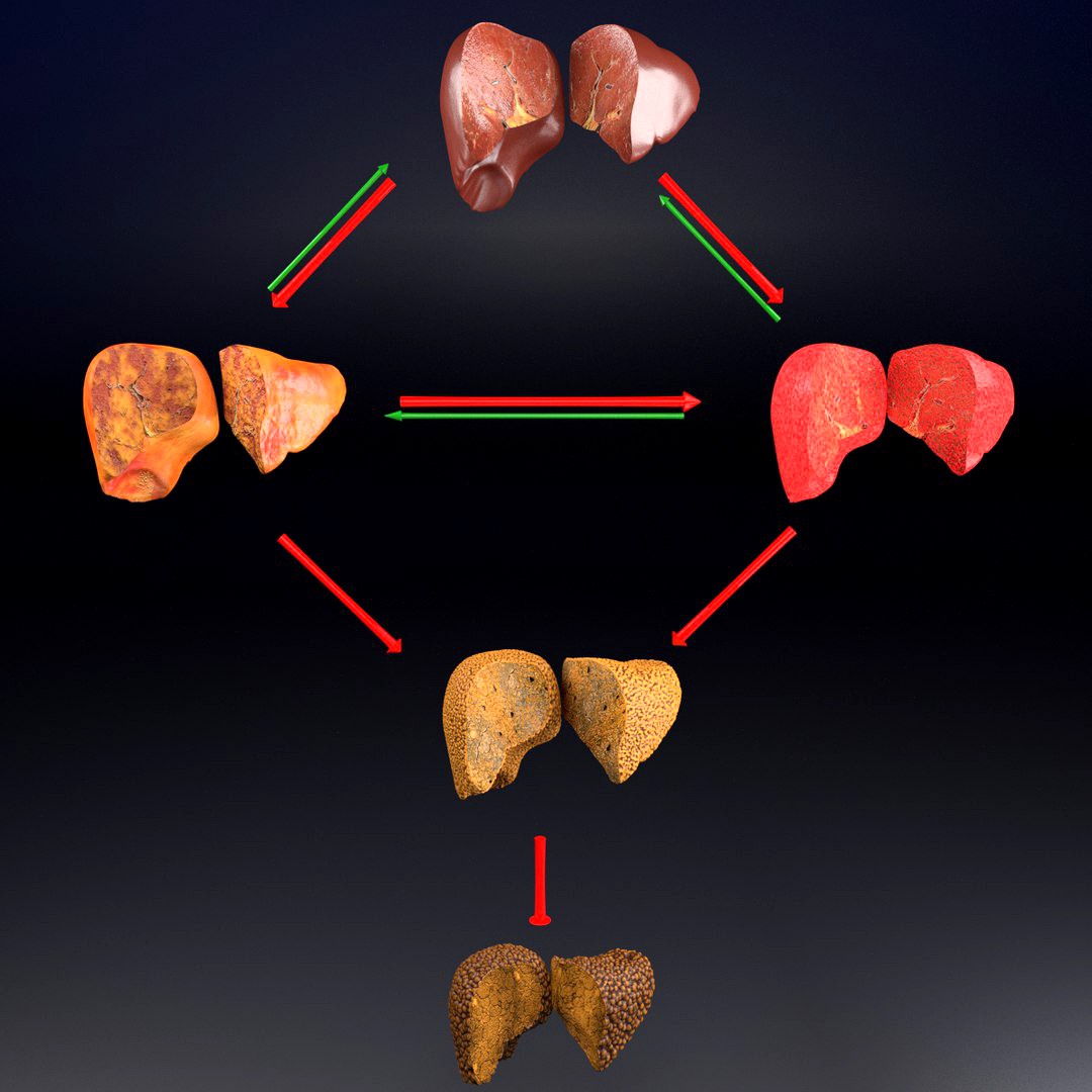 Alchoholic liver disease cirrhosis hepatitis fatty