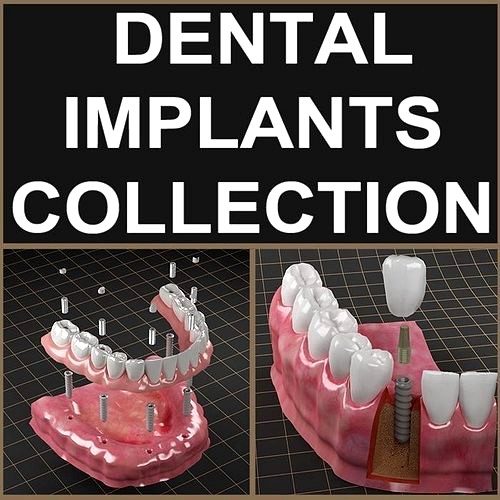 Dental Implant Collection