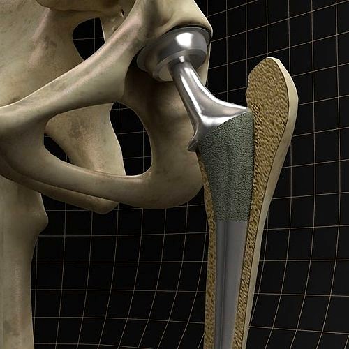 Femoral prosthesis with complete skeleton and section femur