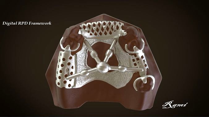 Digital Removable Partial Denture Framework | 3D