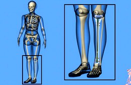 Tibial Intramedullary Nail