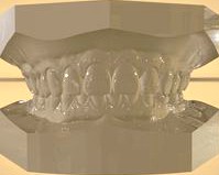 Digital Orthodontic Study Models with Virtual Bases