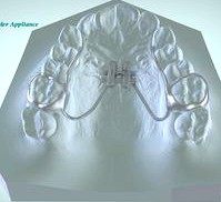 Digital Rapid Palatal Expander