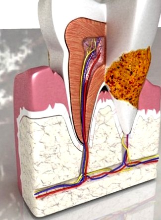 Tooth Dental Plaque High Detail 3D Model