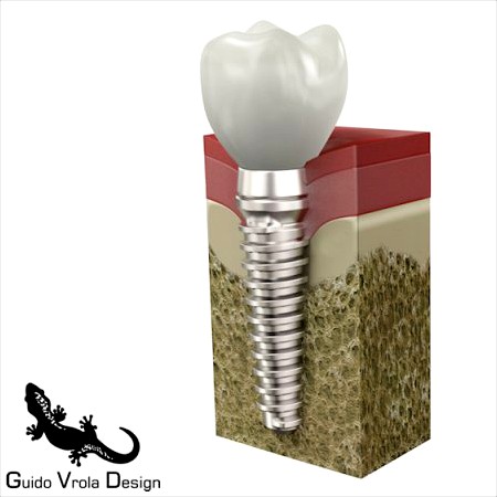 Dental Implant 3D Model