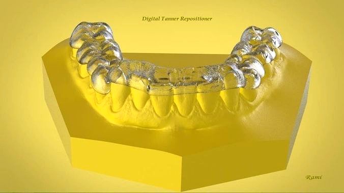 Digital Ortho Tanner Repositioner  | 3D