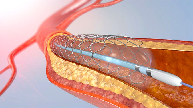 Blood vessel and Medical Artery Stent 3d model