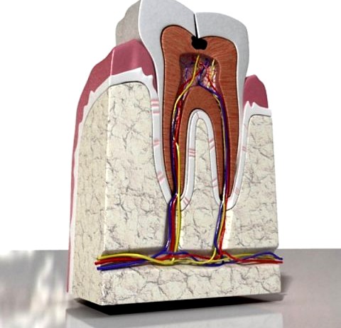 Cracked Tooth High Detail 3D Model