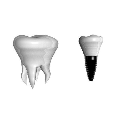 Tooth white implant dentistry prosthetics