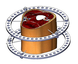 Устройство внешней фиксации. Аппарат Илизарова. External fixation device (bone). The Ilizarov apparatus.