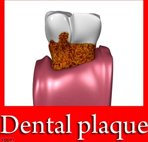 Tooth with Dental Plaque3d model