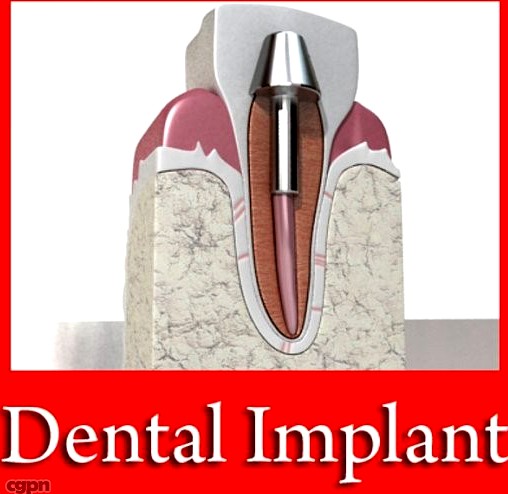 Dental Implant3d model