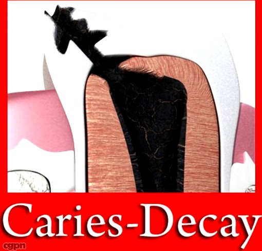 Tooth Pathologies : Caries - Decay.3d model