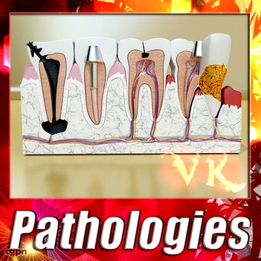 Tooth Pathologies3d model