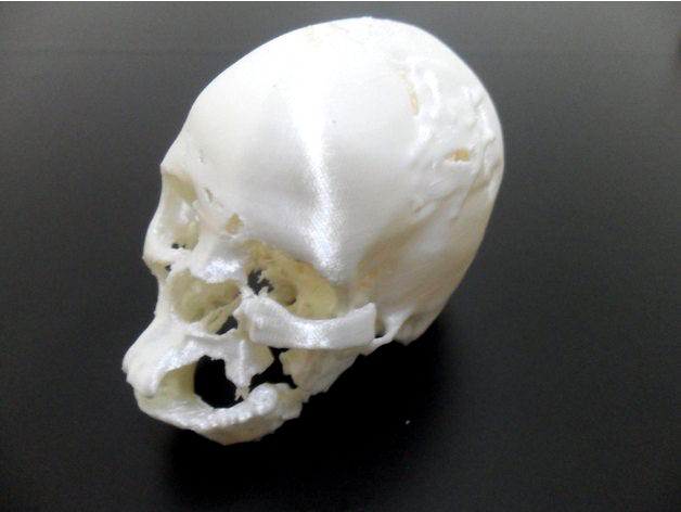 Post surgery traumatized skull by MarioDiniz