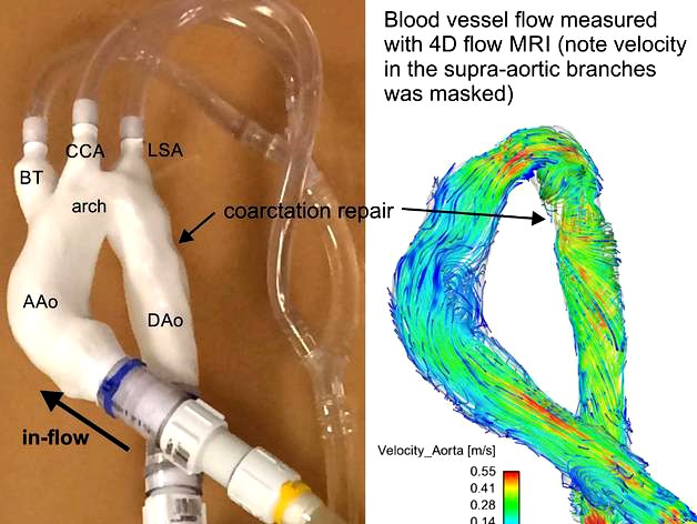 Surgically repaired coarctation of the aorta (flow model) by l8aarx