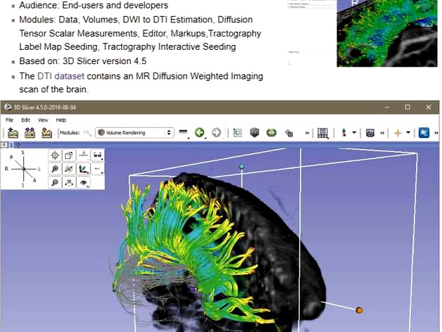 Printable Diffusion MRI analysis Brain tracts  by marcotronic