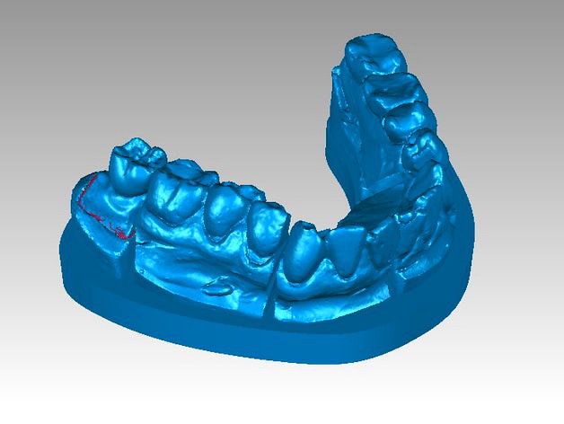 implant-supported crown by eki27