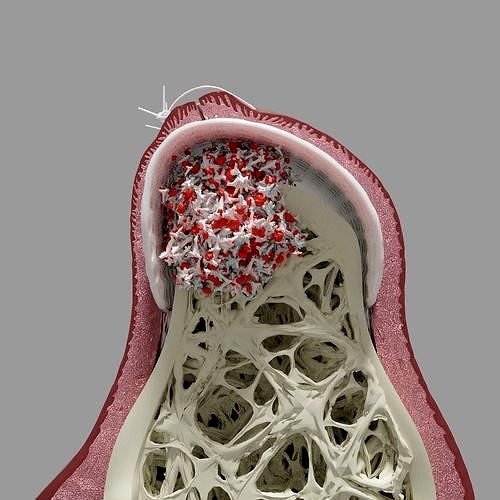 Bone Grafting