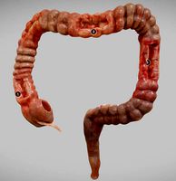 Crohns Disease