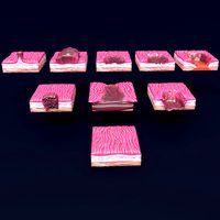 Gastric stomach cancer stages labelled