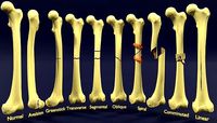 Fracture types labelled