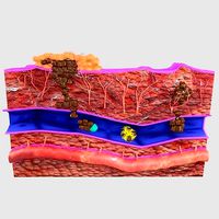 cancer metastasis spread