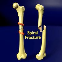 Spiral Fracture skeleton labelled femur