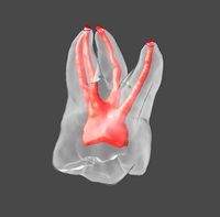 Maxillary 1st molar right and left with 4 canals | 3D