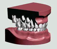 Mix dentition model with individual teeth | 3D