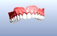 Digital denture  bridged teeth